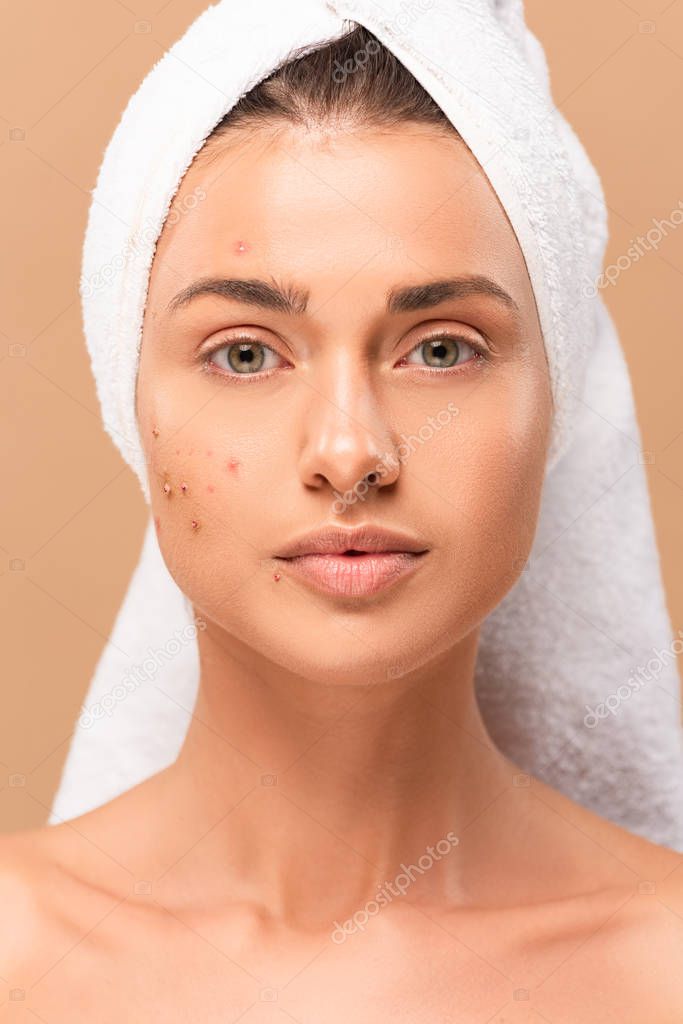 nude girl in towel with acne on face looking at camera isolated on beige 