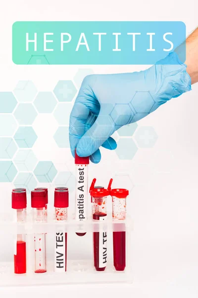 青いラテックス手袋の科学者のクロップドビュー白色の肝炎レタリングの近くのテストとサンプルを保持 — ストック写真