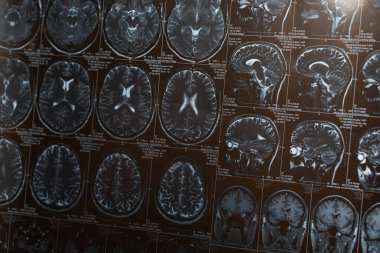 Magnetic resonance imaging of brain, concept of alzheimer disease  clipart