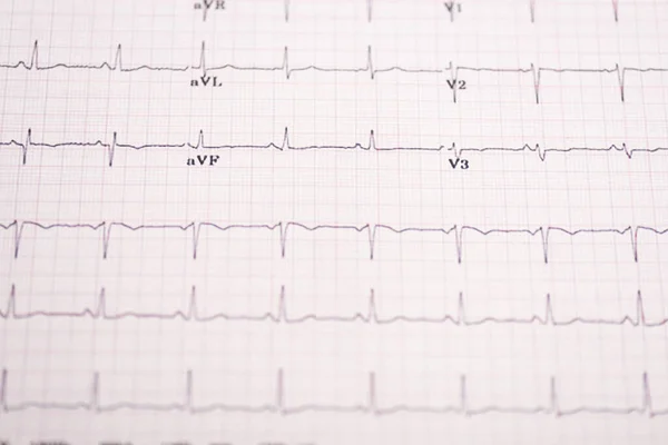 Mise Point Sélective Électrocardiogramme Sur Papier — Photo