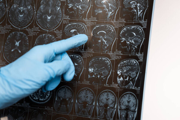 Обрезанный взгляд врача, указывающего на магнитно-резонансную томографию мозга, изолированную от концепции болезни Альцгеймера
 