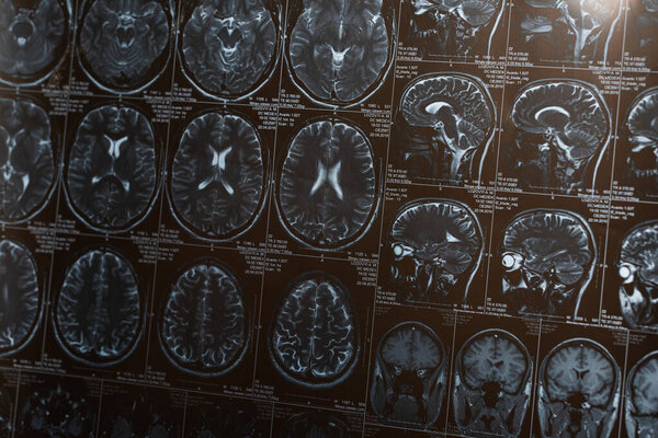 Magnetic resonance imaging of brain, concept of alzheimer disease 