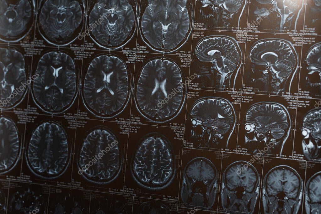 Magnetic resonance imaging of brain, concept of alzheimer disease