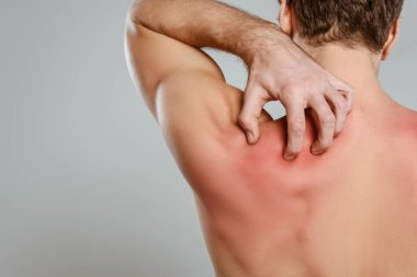 Partial view of man scratching skin with allergy isolated on grey