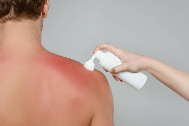 Cropped view of woman applying foam on male back with sunburn isolated on grey clipart
