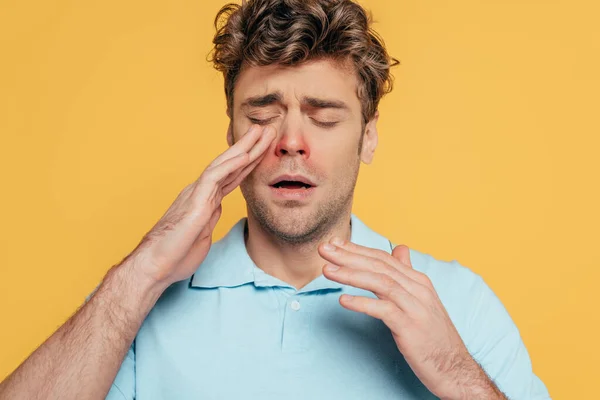 Retrato Hombre Enfermo Con Los Ojos Cerrados Tocando Enrojecimiento Aislado —  Fotos de Stock
