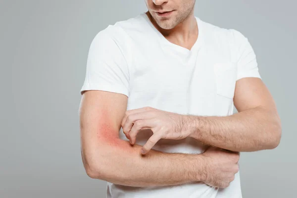 Обрезанный Вид Человека Царапая Руку Аллергией Изолированы Серый — стоковое фото