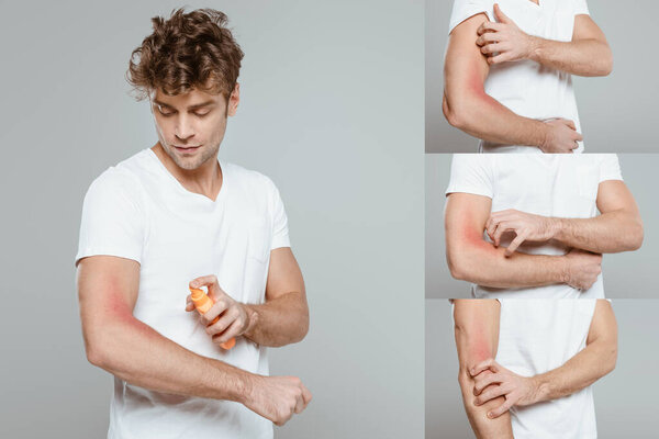 Коллаж человека, наносящего солнцезащитный крем и царапающего руку с аллергией на серый
