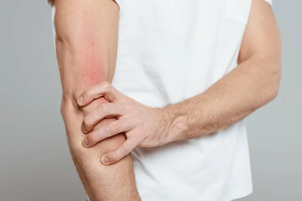 Widok Człowieka Dotykającego Dłoni Wyizolowaną Szaro Alergią — Zdjęcie stockowe