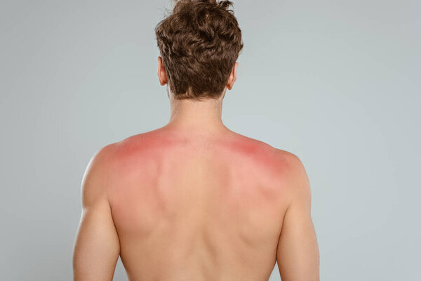 Back view of man with sunburn isolated on grey 