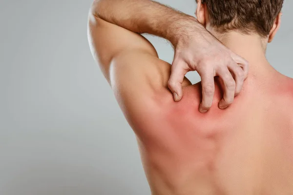 Vue Partielle Homme Qui Gratte Peau Avec Une Allergie Isolée — Photo