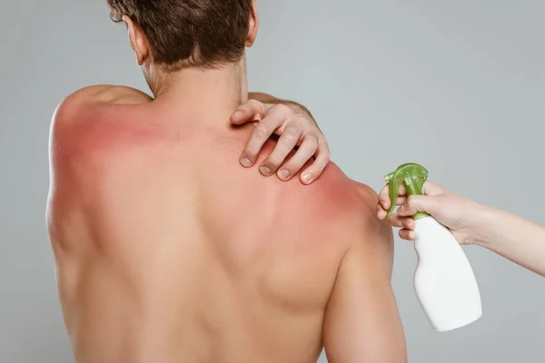 Cropped View Woman Bottle Spray Man Touching Skin Sunburn Isolated — Stock Photo, Image
