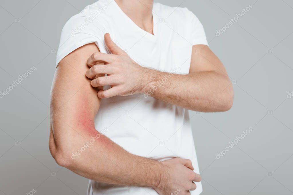 Partial view of man scratching hand with allergy isolated on grey