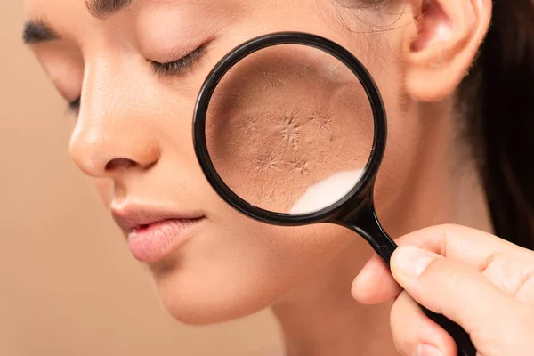 Vista recortada de hombre sosteniendo lupa cerca de mujer joven con problema de piel aislada en beige — Stock Photo