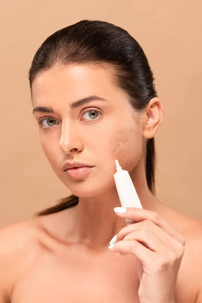 Ragazza nuda che tiene la crema di trattamento vicino al viso con la pelle problema e guardando la fotocamera isolata sul beige — Foto stock