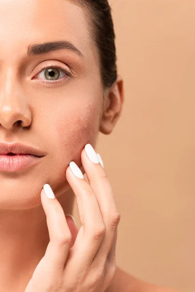 Vista ritagliata della ragazza che tocca il viso con la pelle problema e guardando la fotocamera isolata sul beige — Foto stock