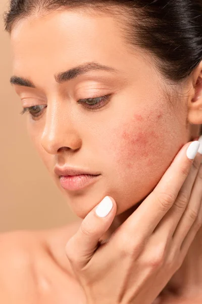 Naked girl touching face with problem skin isolated on beige — Stock Photo