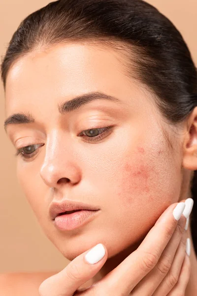 Mujer joven tocando la cara con la piel problema aislado en beige — Stock Photo