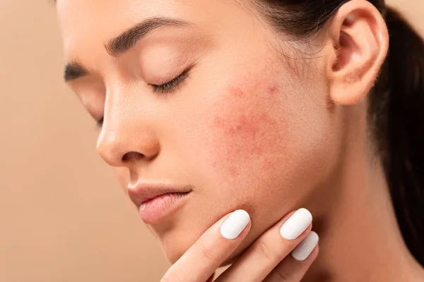 Mujer joven con los ojos cerrados tocando la cara con acné aislado en beige — Stock Photo