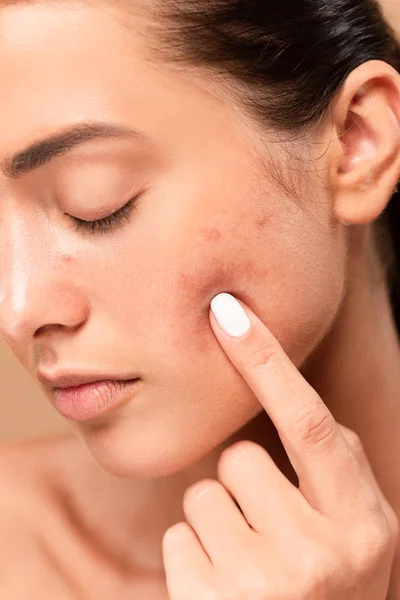 Mujer joven señalando con el dedo en la cara con la piel problema aislado en beige — Stock Photo