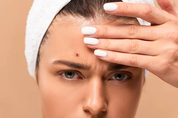 Cropped view of young naked woman with pimple on face touching forehead isolated on beige — Stock Photo