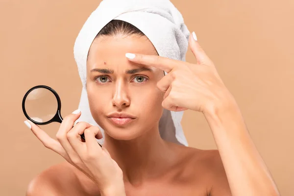 Displeased girl pointing with finger at pimple on face and holding magnifier isolated on beige — Stock Photo