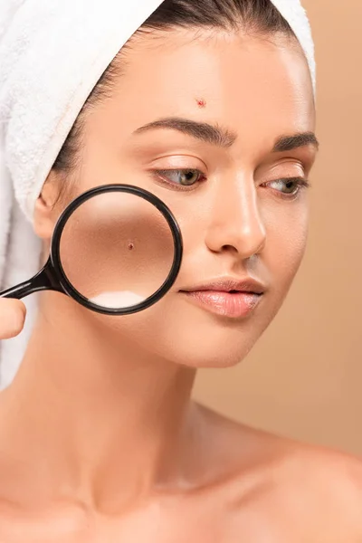 Young nude woman with pimples on face holding magnifier isolated on beige — Stock Photo