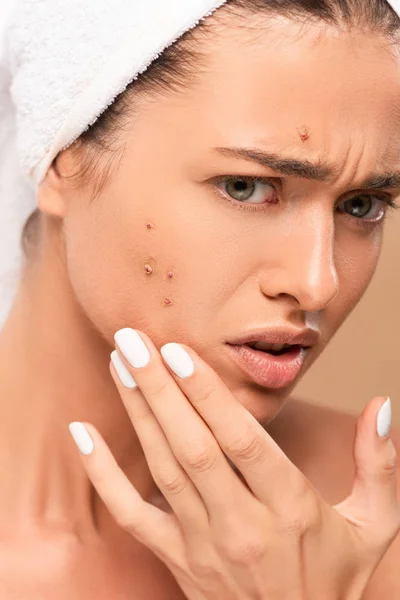 Femme bouleversée dans la serviette toucher le visage avec l'acné isolé sur beige — Photo de stock