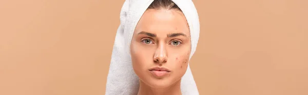 Panoramic shot of woman in towel with acne on face isolated on beige — Stock Photo