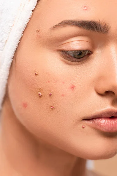 Close up of girl with acne on face isolated on beige — Stock Photo