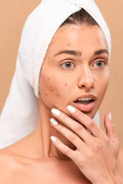 Choqué et nu fille en serviette toucher visage avec acné isolé sur beige — Photo de stock
