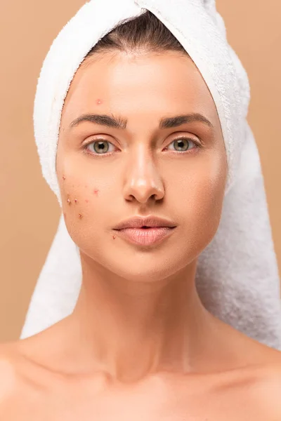 Nude girl in towel with acne on face looking at camera isolated on beige — Stock Photo