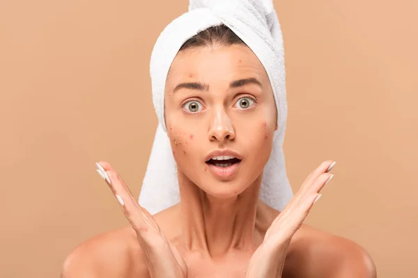 Sorpreso ragazza nuda in asciugamano con acne sul viso guardando la fotocamera isolata sul beige — Foto stock