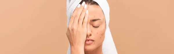 Panoramic shot of girl with acne covering face isolated on beige — Stock Photo