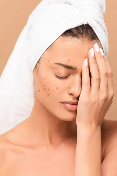 Frustrated and nude girl with acne covering face isolated on beige — Stock Photo