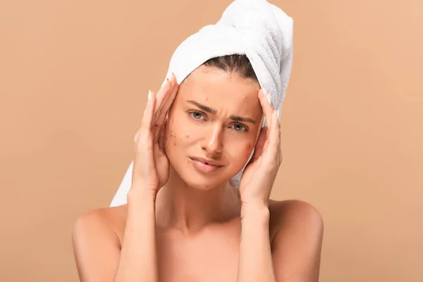 Frustrated girl with acne on face looking at camera isolated on beige — Stock Photo