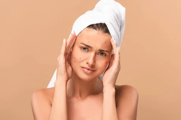 Frustrata ragazza con acne sul viso guardando la fotocamera isolata sul beige — Foto stock