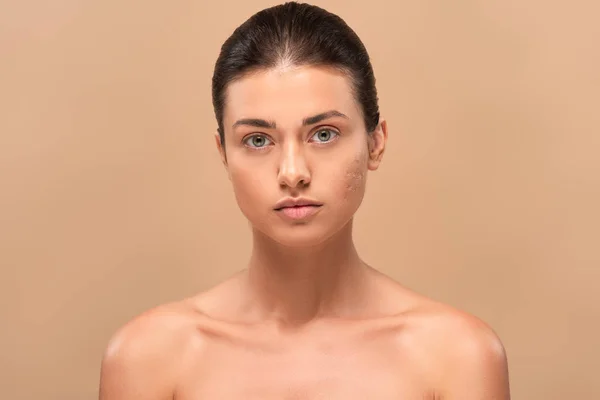 Giovane donna nuda con la pelle problema guardando la fotocamera isolata sul beige — Foto stock