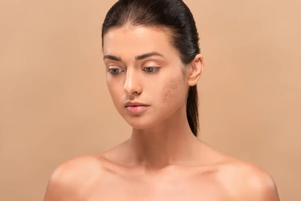 Young naked woman with problem skin isolated on beige — Stock Photo