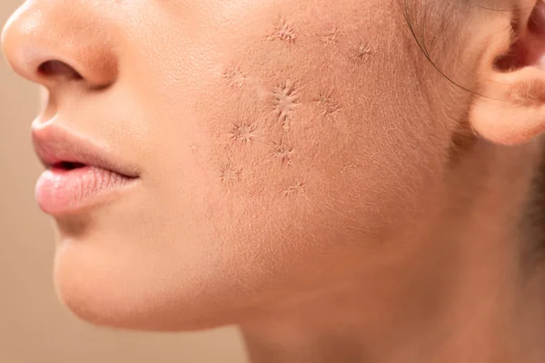 Cropped view of young woman with blemished skin isolated on beige — Stock Photo