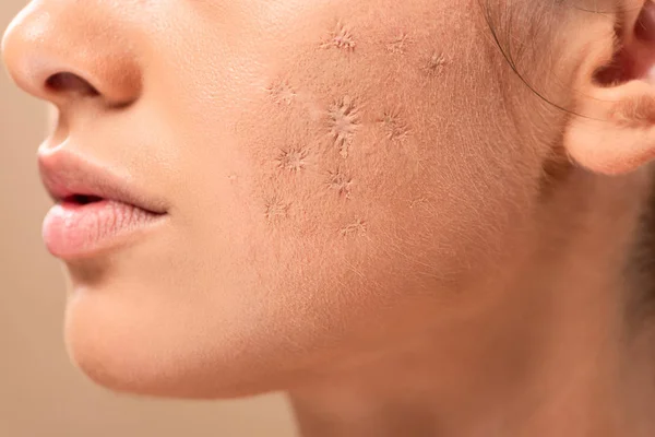 Vista recortada de mujer joven con la piel manchada aislada en beige — Stock Photo