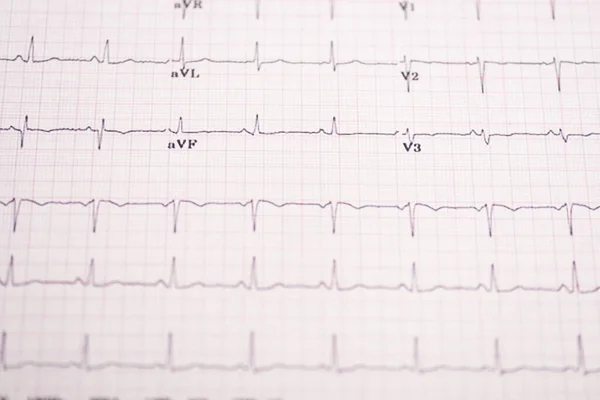 Selective focus of electrocardiogram on paper — Stock Photo