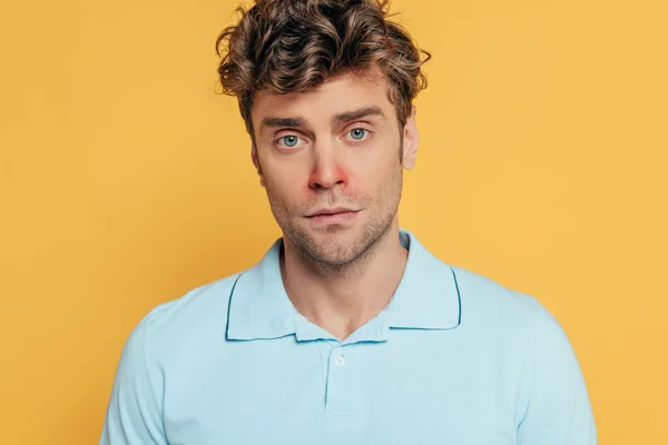 Portrait of sick man with redness on nose isolated on yellow — Stock Photo