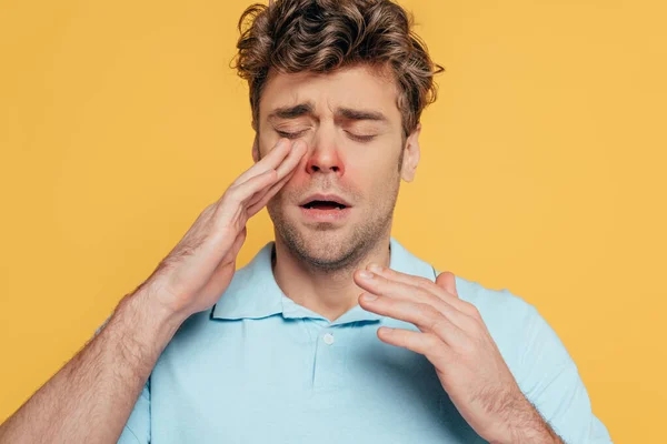Porträt eines kranken Mannes mit geschlossenen Augen, der Rötungen berührt, isoliert auf gelb — Stockfoto
