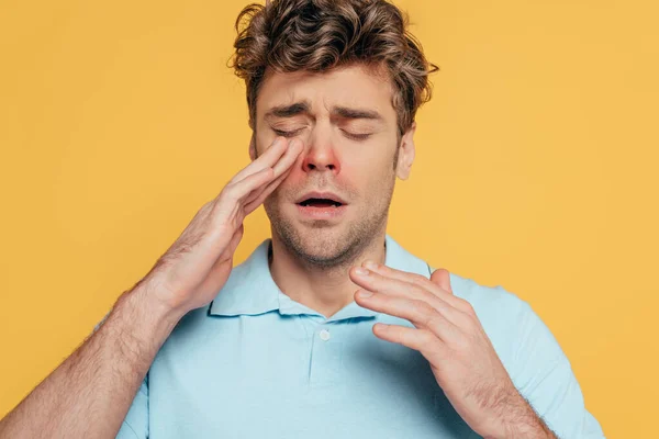 Portrait d'un homme malade aux yeux fermés touchant une rougeur isolée sur du jaune — Photo de stock