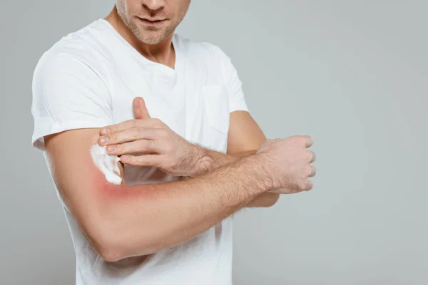 Cropped view of man applying foam on hand with redness isolated on grey — Stock Photo