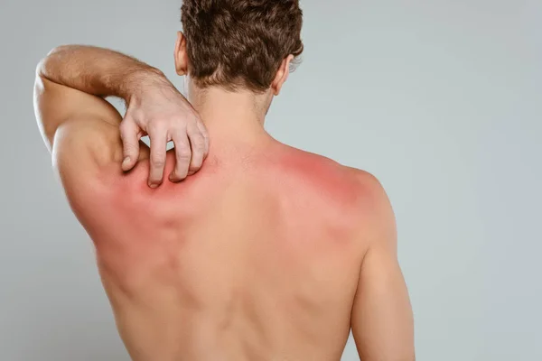 Вид ззаду чоловіка подряпає шкіру з алергією ізольовано на сірому — стокове фото