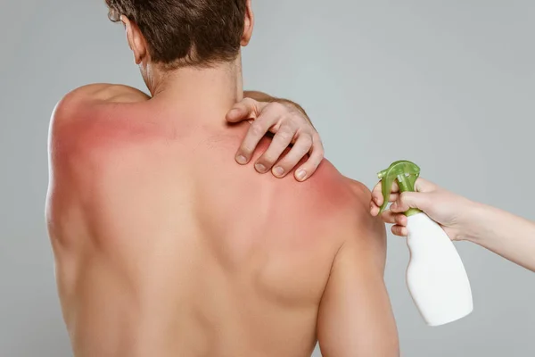 Ausgeschnittene Ansicht einer Frau mit Sprühflasche in der Nähe eines Mannes, der Haut mit Sonnenbrand berührt, isoliert auf grau — Stockfoto