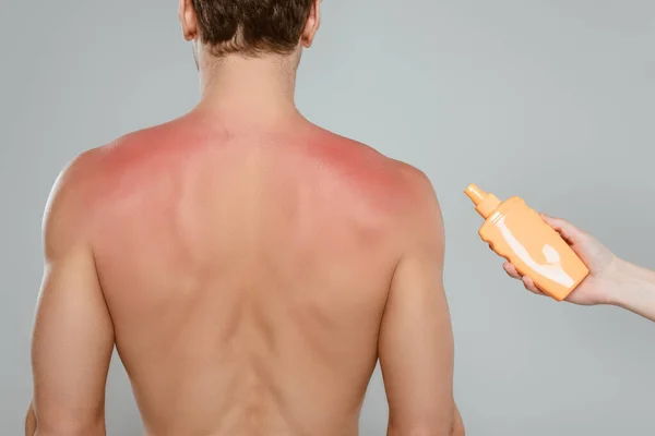 Vista recortada de una mujer sosteniendo una botella de protector solar cerca de un hombre con quemaduras solares aisladas en gris - foto de stock