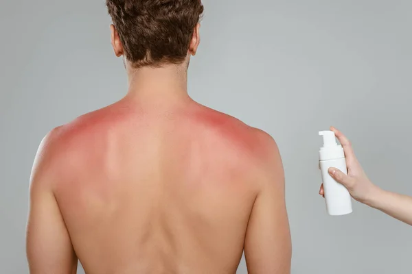 Vue recadrée de la femme tenant une bouteille de mousse près de l'homme avec des coups de soleil isolés sur gris — Photo de stock